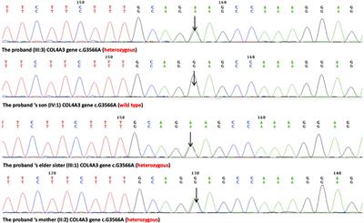 Case Report: Identification of a Novel Heterozygous Missense Mutation in COL4A3 Gene Causing Variable Phenotypes in an Autosomal-Dominant Alport Syndrome Family